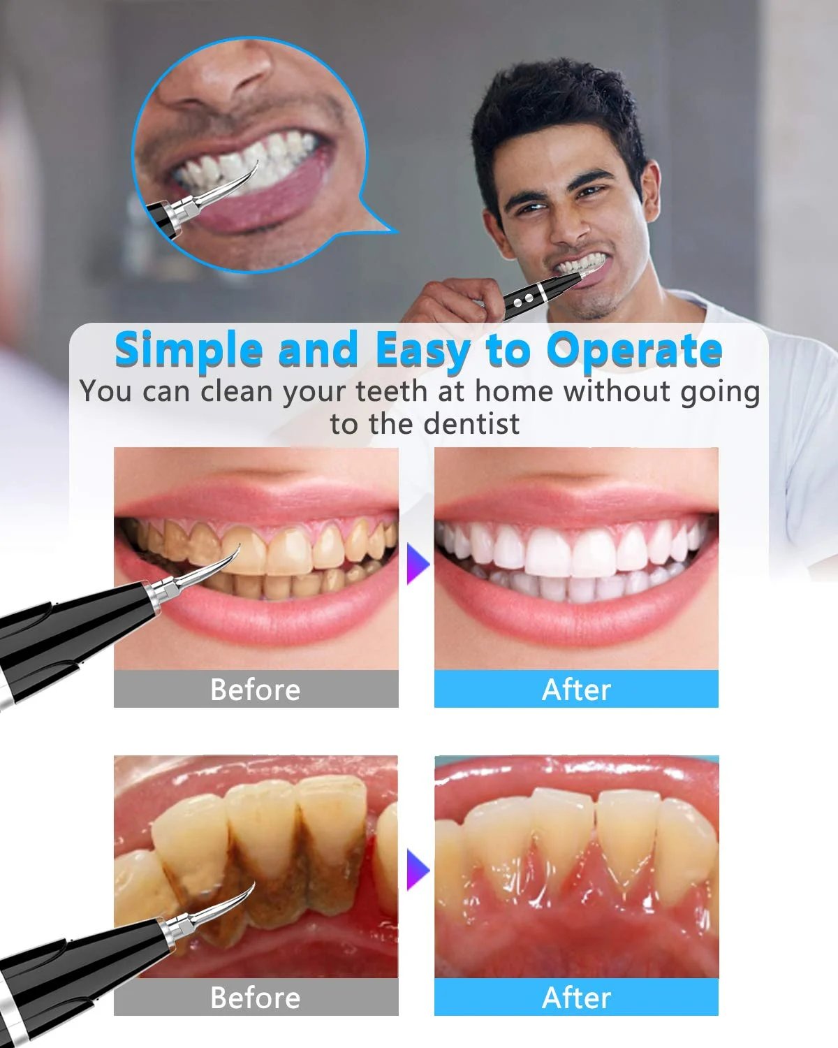 (👨⚕🦷Buy 2 Free Shipping)Electric tooth cleaning instrument -Teeth Cleaner